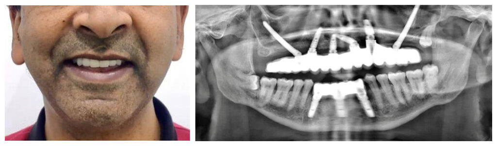 Zygomatic Implants in India