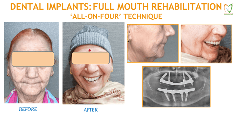 dental implants all-on-four technique