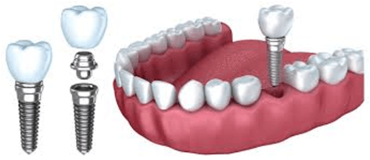 dental implants cost in India