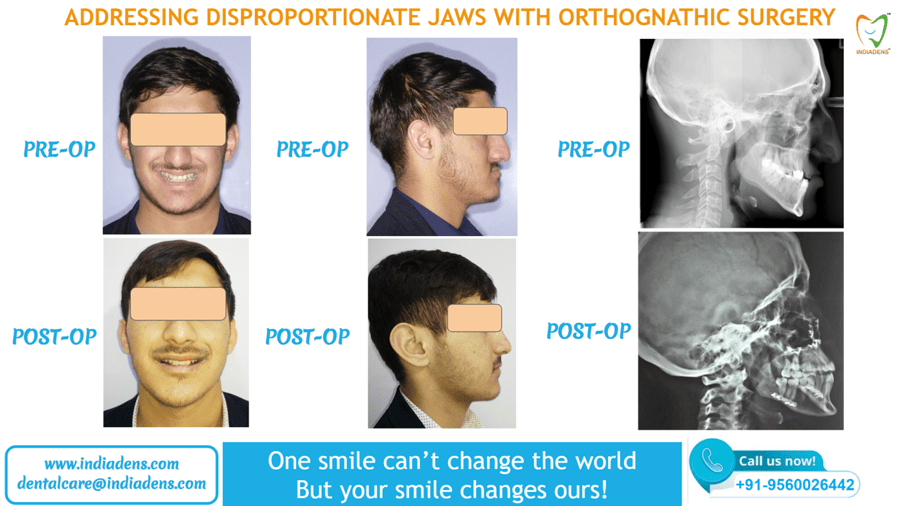 Corrective Jaw Orthognathic Surgery in India by Dr Ujjwal Gulati