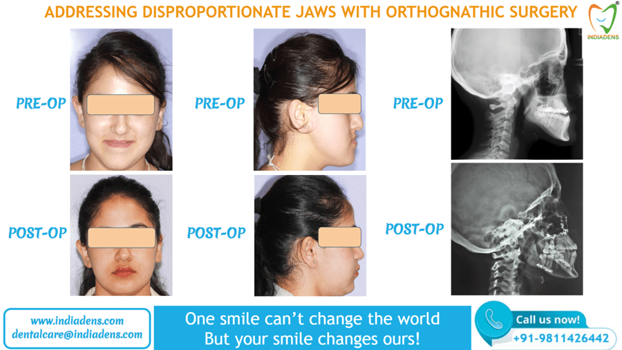 Surgeries for Teeth Alignment, Jaw Surgery - best orthodontist in Delhi