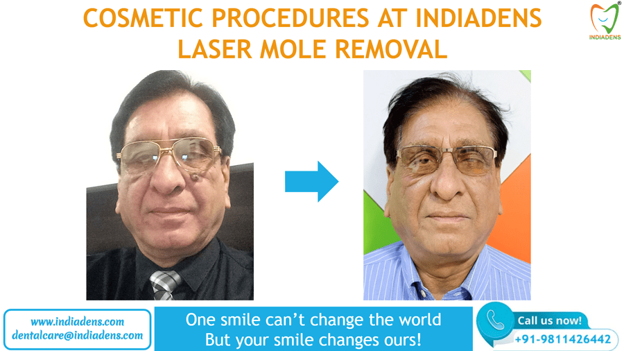 laser mole removal centre in Delhi India