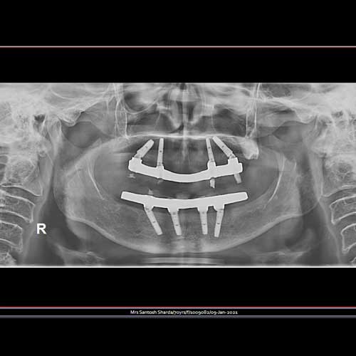 Dental Implant OPG Showing All-on-4
