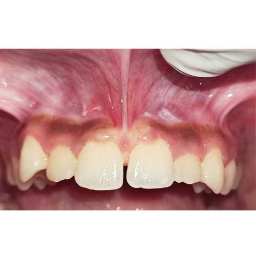 laser treatment frenectomy removal before