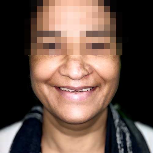 Patient Photo Before Digital Smile Design with Veneers