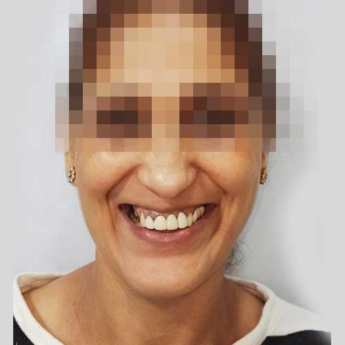 Patient Photo Before Smile Designing