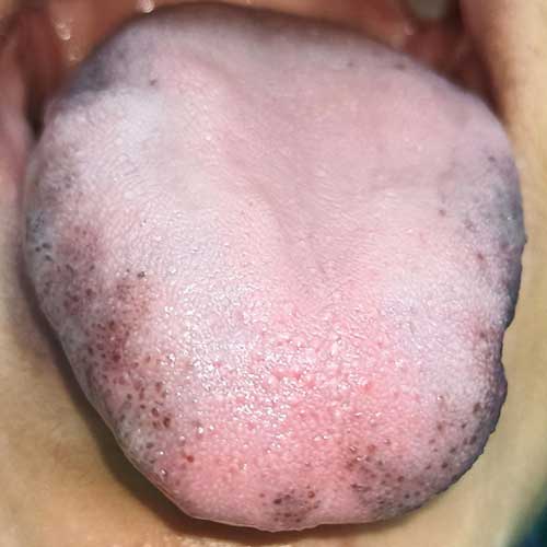 laser treatment tongue depigmentation before