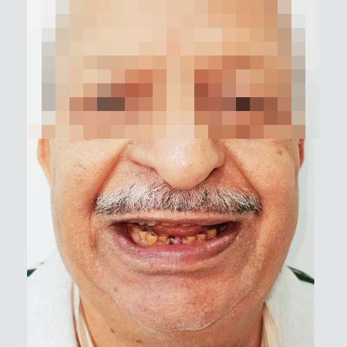Dental Patient Photo Before Smile Designing