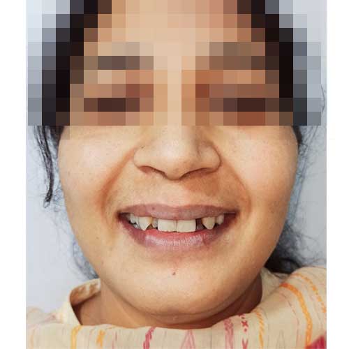 Dental Patient Photo Before Smile Makeover