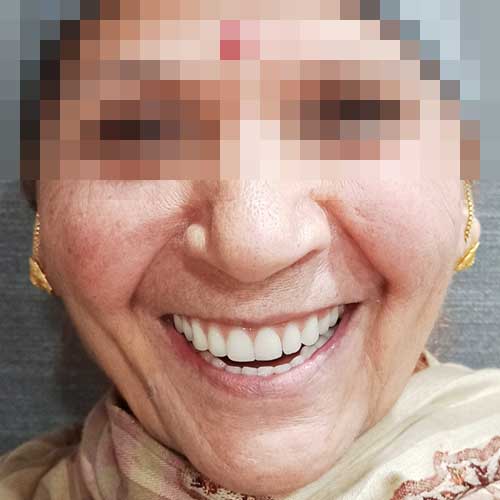 Dental Patient Smile Photo After Dental Implant All on 4 Treatment