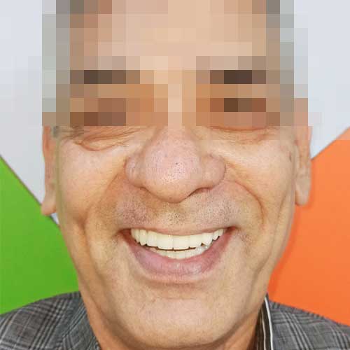 Dental Patient Smile Photo After Full arch dental implant prosthesis using all on 6 technique