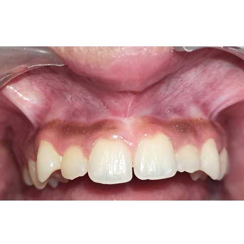 laser treatment frenectomy removal after