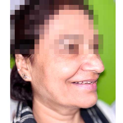 Patient Photo Before Digital Smile Design with Veneers