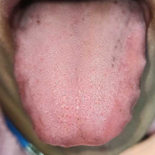 laser treatment tongue depigmentation After