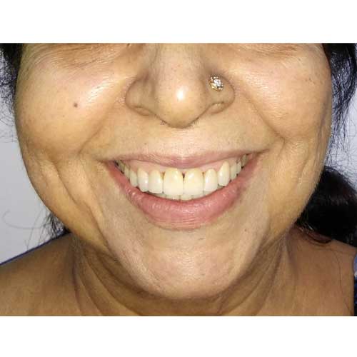 Smile Designing Patient Photo After E-max Veneers