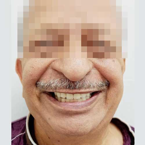 Dental Patient Photo After Smile Designing using Zirconia Crowns and Implant Prosthesis