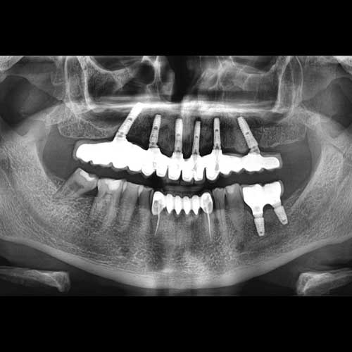 Full arch dental implant prosthesis OPG