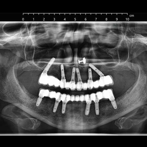Full Mouth Rehabilitation Using Implants All-on-6 Procedure OPG