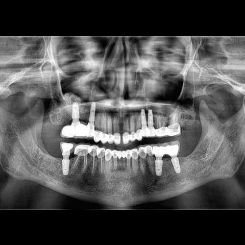 Dental Patient OPG