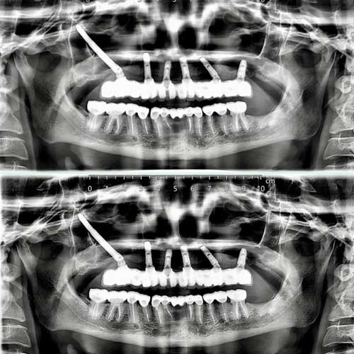 Zygomatic Implant All on 6