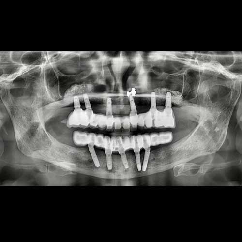 Full Mouth Rehabilitation All on 6 Dental Implant Technique