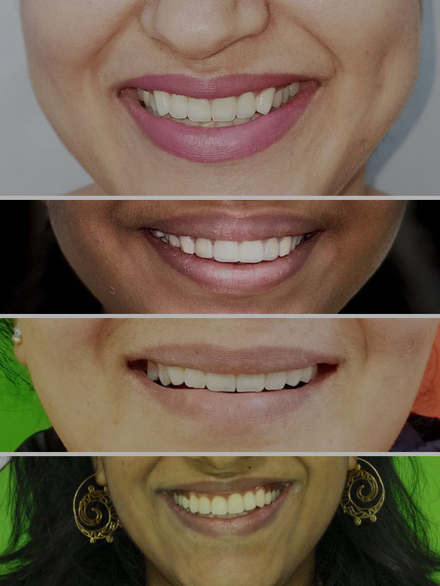 Smile Designing / Makeover Treatment Before and After Photos