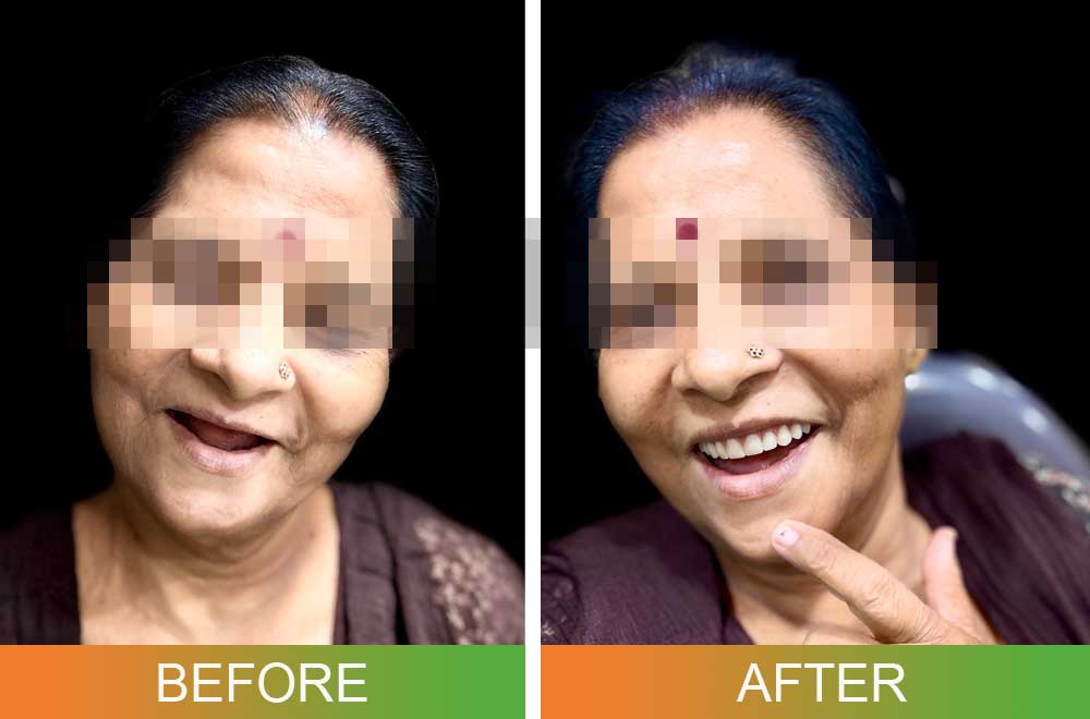 Dental Implant Overdentures before and after photos