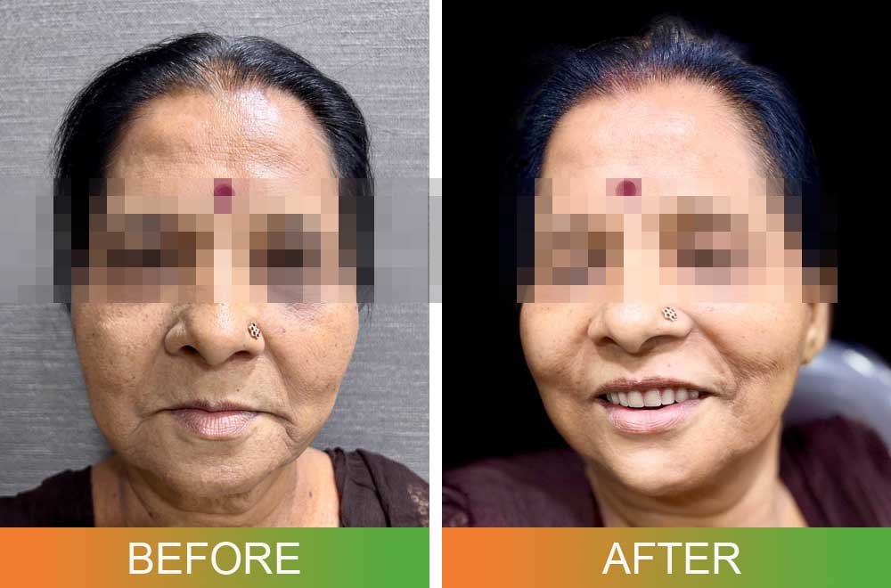 Dental Implant Overdentures before and after photos