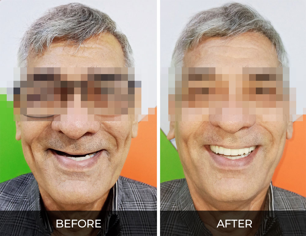 Implant Supported Fixed Teeth before and after treatment results