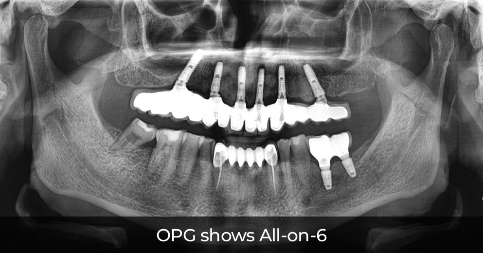 OPG All on 6 dental implant