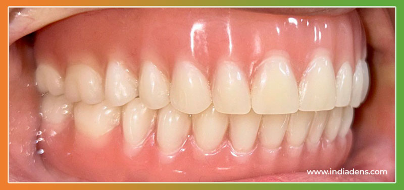 dental implant overdenture result