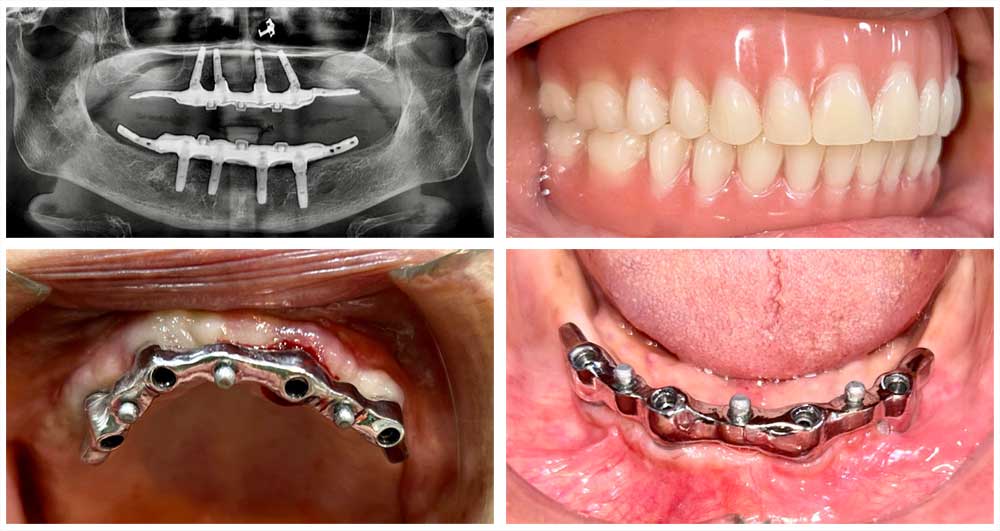 implant overdentures