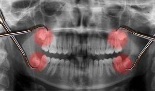 wisdom tooth removal