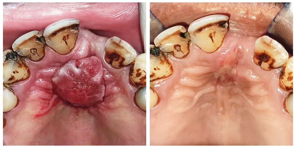 Tumour Removal Using Laser