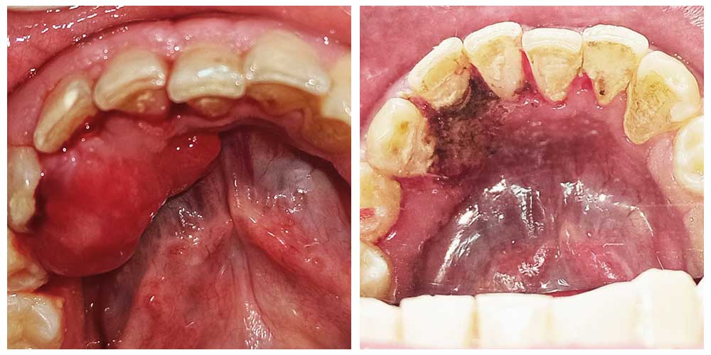 Tumour Removal Using Laser