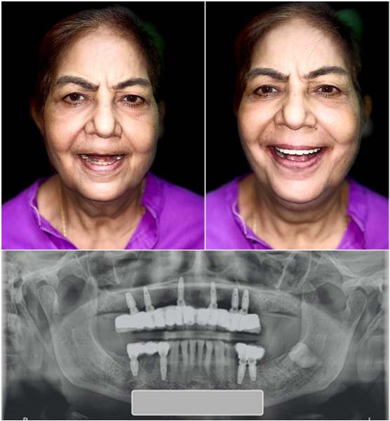 Full Mouth Dental Implants by Dr Ujjwal Gulati