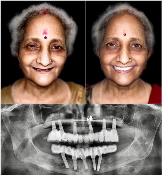 Full Arch Teeth on Implants by Dr Ujjwal Gulati