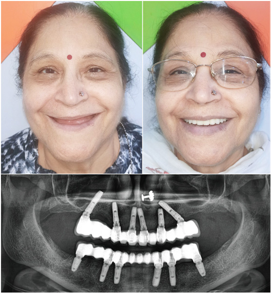 Full Mouth Dental Implants by Dr Ujjwal Gulati