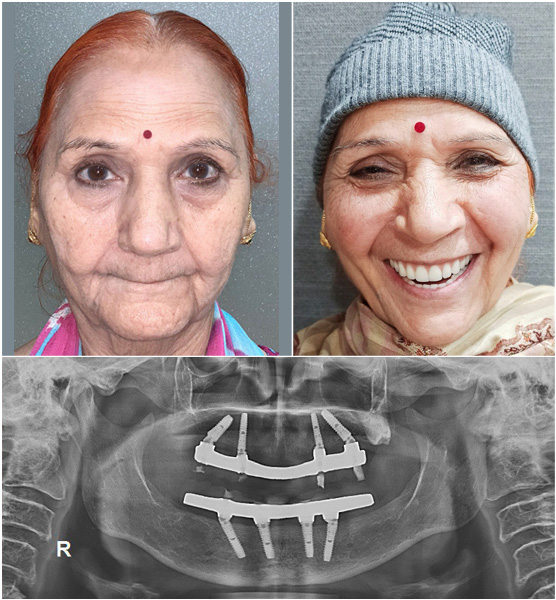 Full Mouth Dental Implants by Dr Ujjwal Gulati