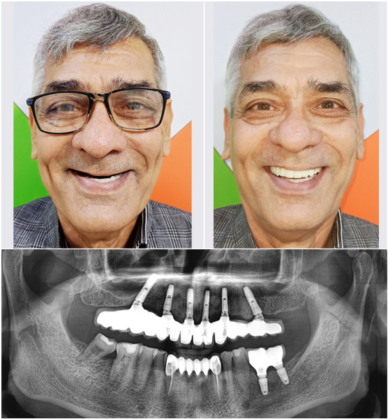 Full Mouth Dental Implants by Dr Ujjwal Gulati