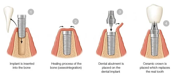 dental implant treatment procedure