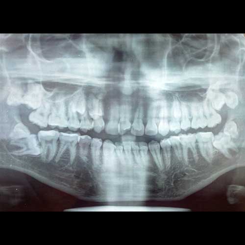 wisdom teeth PRE-OP OPG