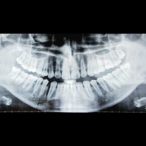 LOWER JAW FRACTURE
