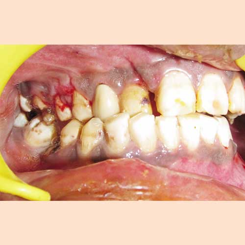 ZYGOMA FRACTURE PRE-OP