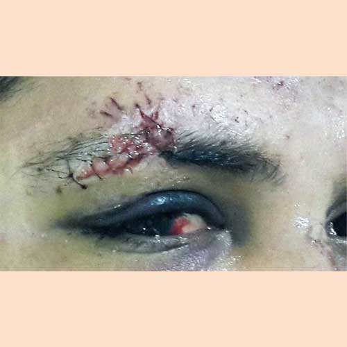 ORBITAL FRACTURE