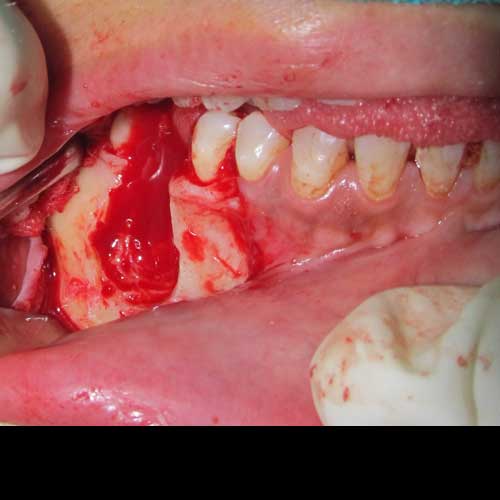 tumour excision surgery