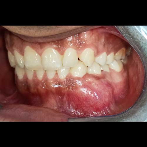 Ameloblastoma Tumor