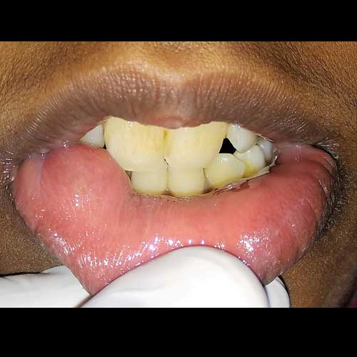 MUCOCELE