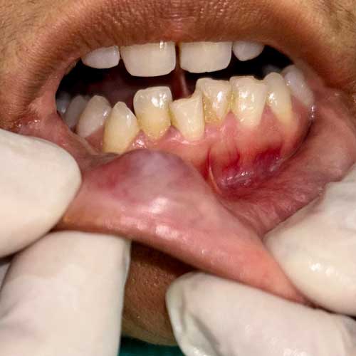 Salivary Pseudocyst