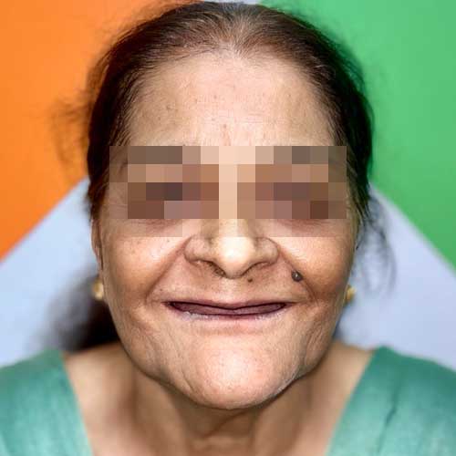 Patient Photo Before Implant Retained Prosthesis